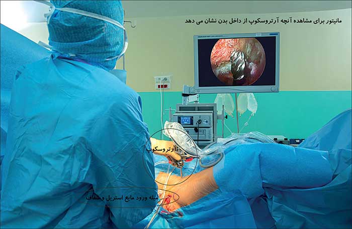 روند جراحی Arthroscopy