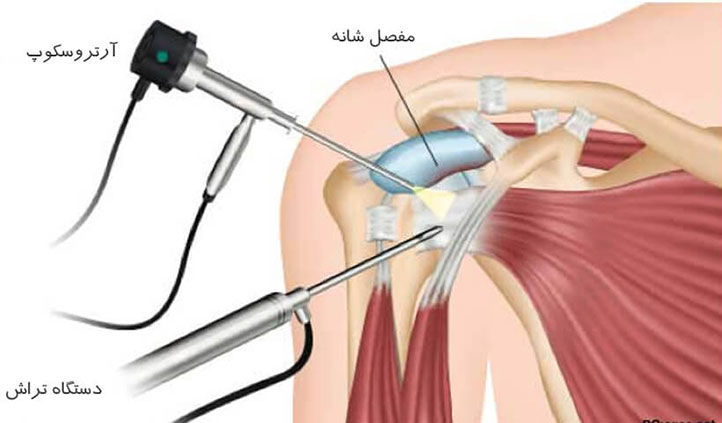 عمل جراحی آرتروسکوپی یا بسته شانه
