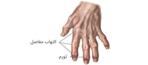 آرتروز مچ دست