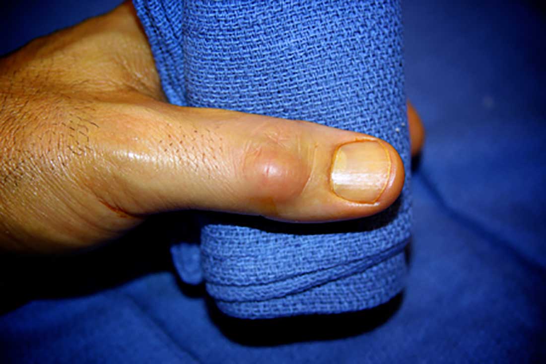 درمان کیست انگشت دست