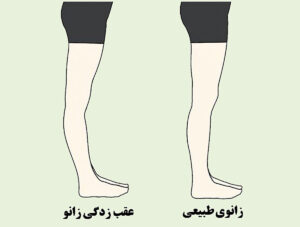 عقب زدگی زانو