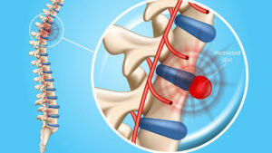 تشخیص دیسک کمر از روی mri