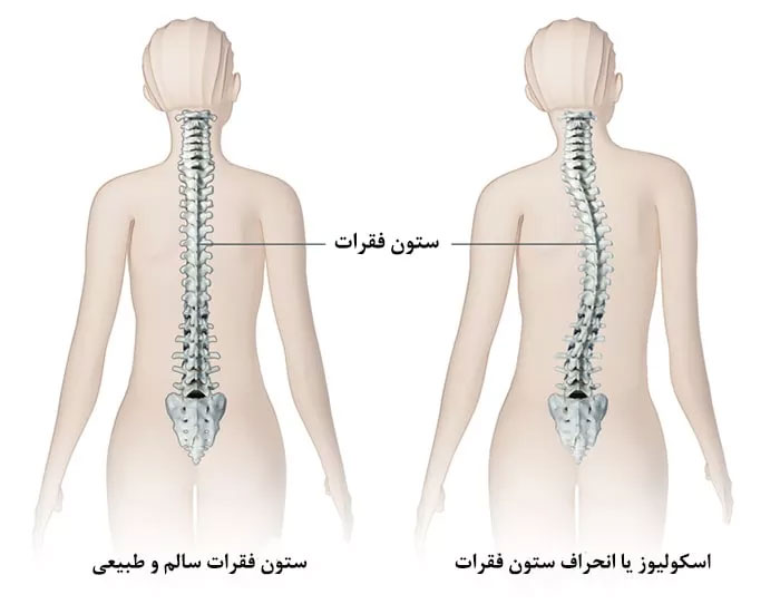 خمیدگی ستون فقرات کودکان