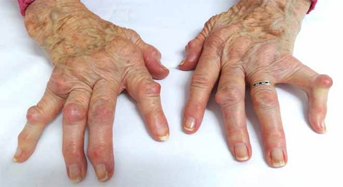 علت تغییر شکل انگشتان دست