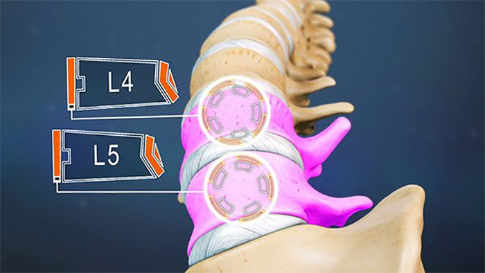 برآمدگی دیسک l5 s1