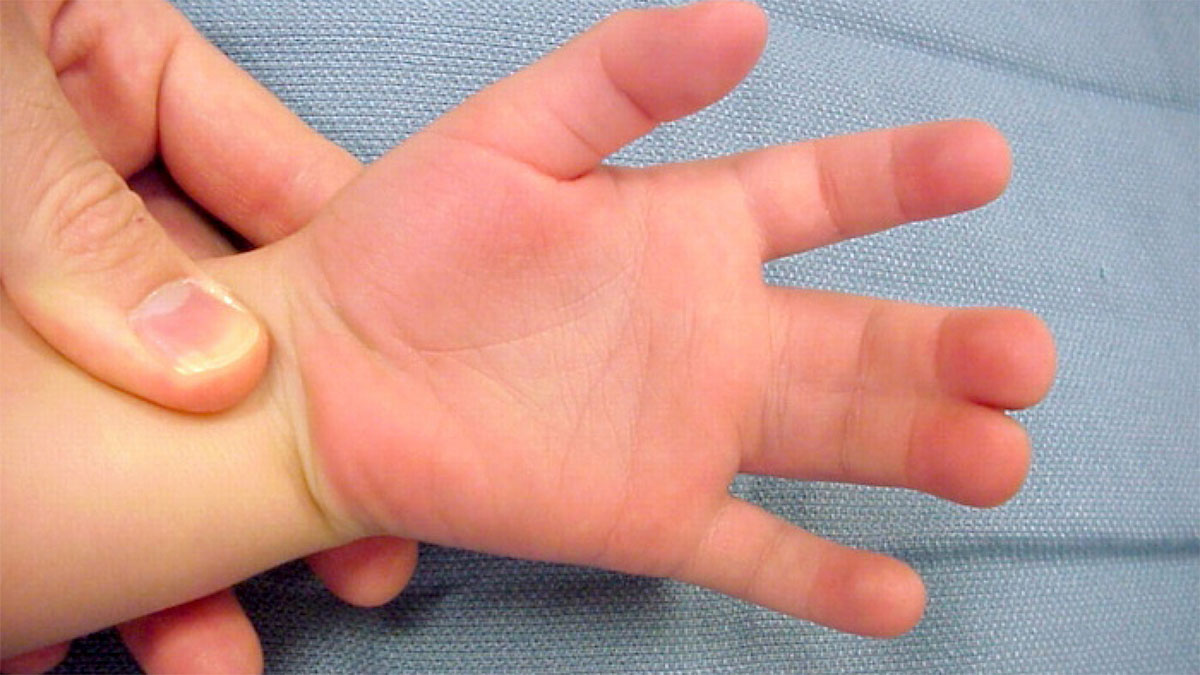 به هم چسبیدگی انگشتان دست چگونه درمان میشود؟