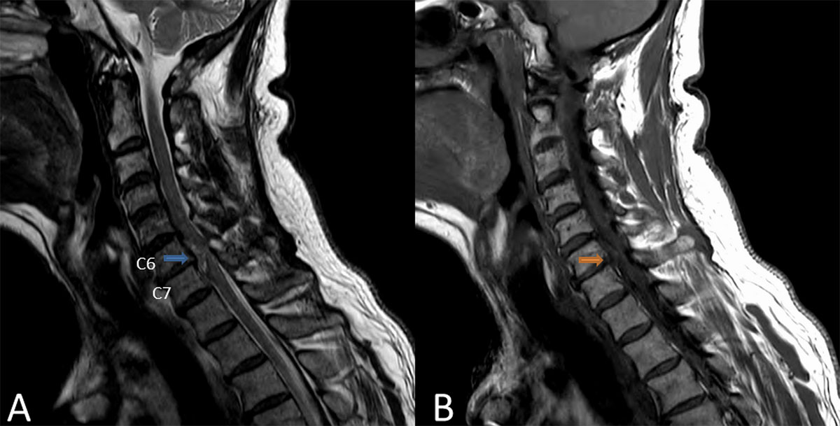 علل پارگی دیسک گردن و روش‌های درمان آن