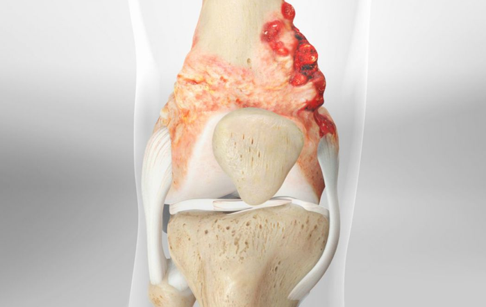خطرات متاستاز استخوان