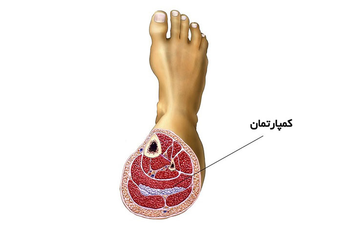علت ایجاد سندرم کمپارتمان