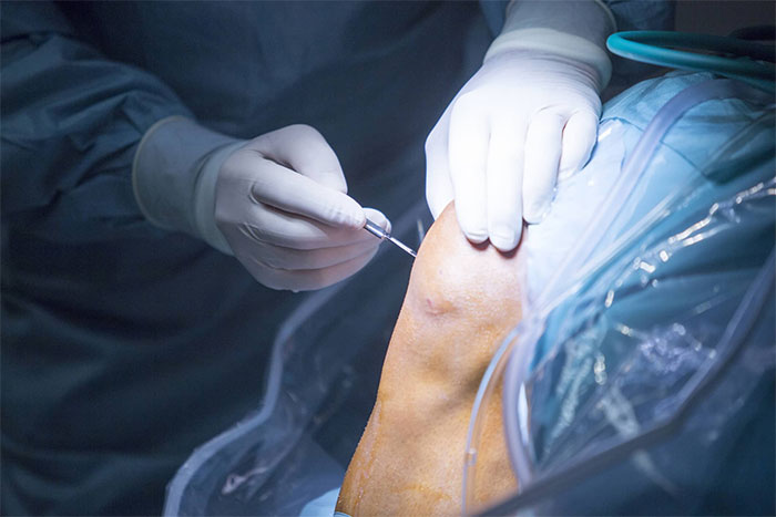 عمل مینیسک زانو چگونه است؟